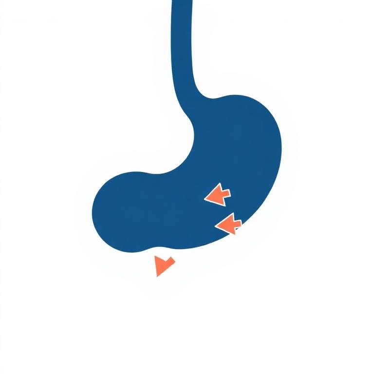 Ilustración médica de Reflujo gastroesofágico